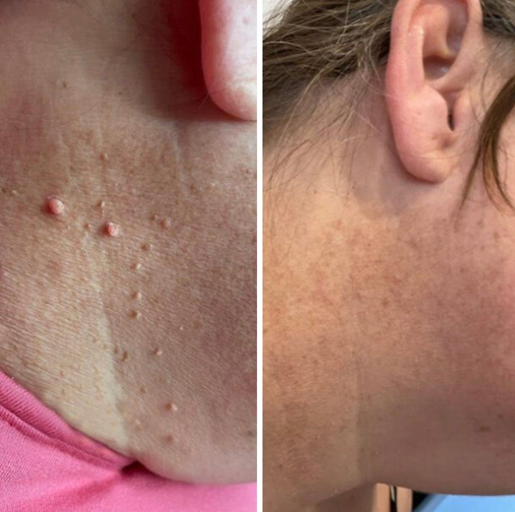 DermoClear™ – Adieu aux acrochordons !